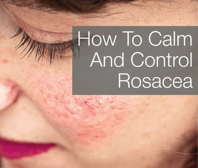 Treating Rosacea with Skin Care By Suzie Oxygen Skin Care featuring A-RO Balsam