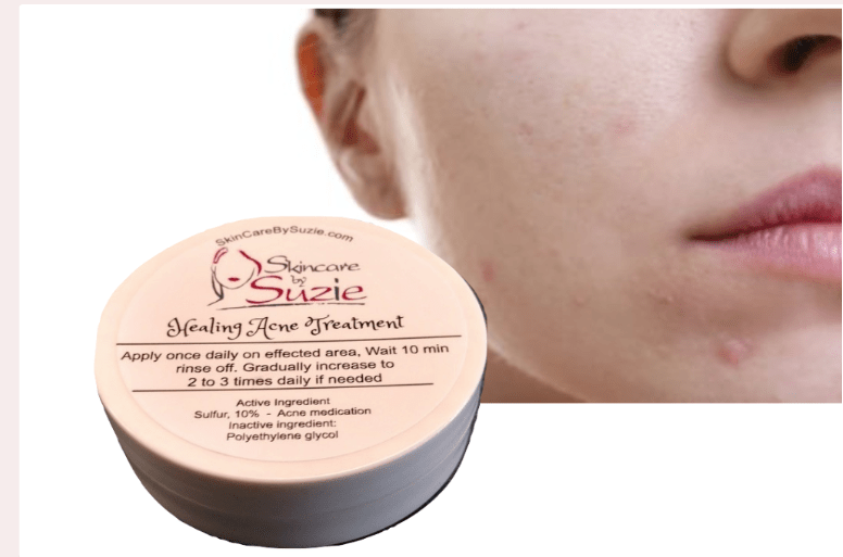 Healing Acne Treatment