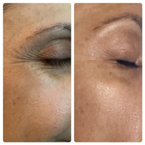 BENECELL Professional Microneedling Regeneration Kit with EGF for Anti-Aging Skin Repair