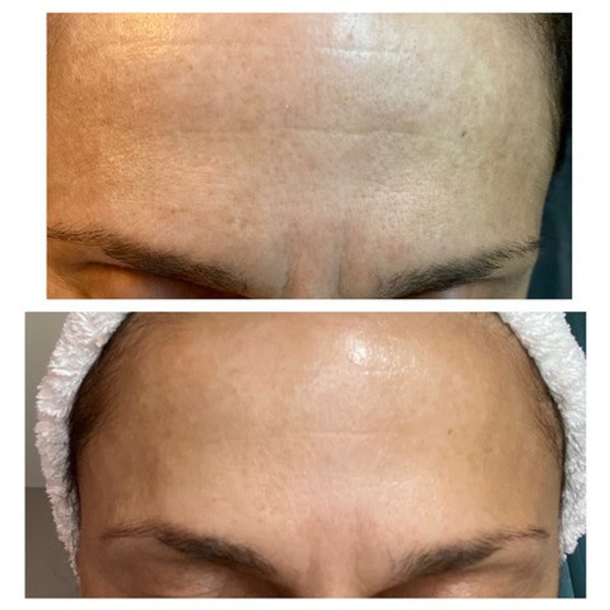 BENECELL Professional Microneedling Regeneration Kit with EGF for Anti-Aging Skin Repair